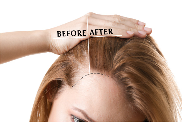 perte-cheveux-3