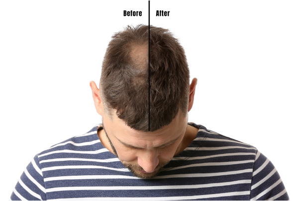 perte-cheveux-1