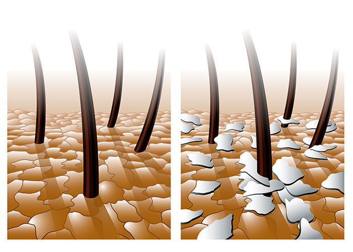 pellicules_grasses_3