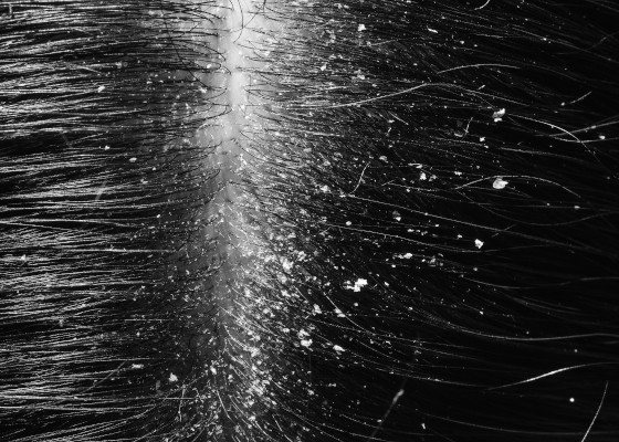 pellicules_grasses_2